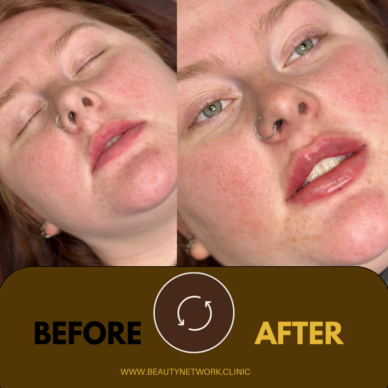 Russian Signature Doll Lip Filler