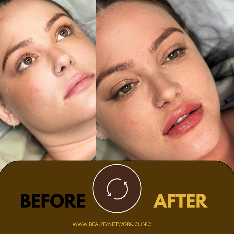 Russian Signature Doll Lip Filler